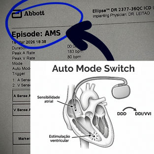 Auto Mode Switch (AMS) ou Mudança Automática de Modo do marcapasso: o que você precisa saber.
