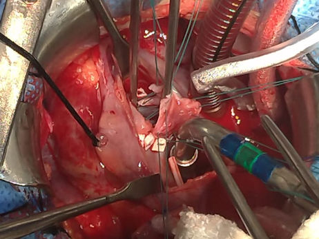 Defeito do Septo Interventricular (CIV) – da anatomia à técnica cirúrgica (resumão)