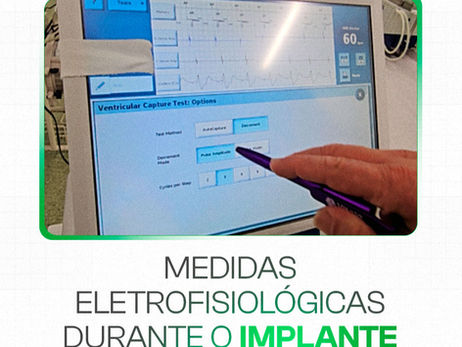 Medidas eletrofisiológicas do marcapasso: o que é e quais são valores de referência | BIZU