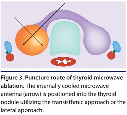 Yang YL, Chen CZ, Zhang XH. Microwave ablation of benign thyroid nodules. Future Oncol. 2014 May;10(6):1007-14. doi: 10.2217/fon.13.260. PMID: 24941986.