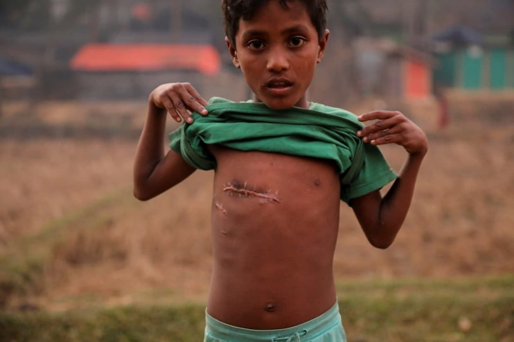 A 7-year-old Rohingya refugee shows a bullet wound on his chest at the Kutupalong refugee camp near Cox’s Bazar, Bangladesh, on Tuesday. (Marko Djurica/Reuters)