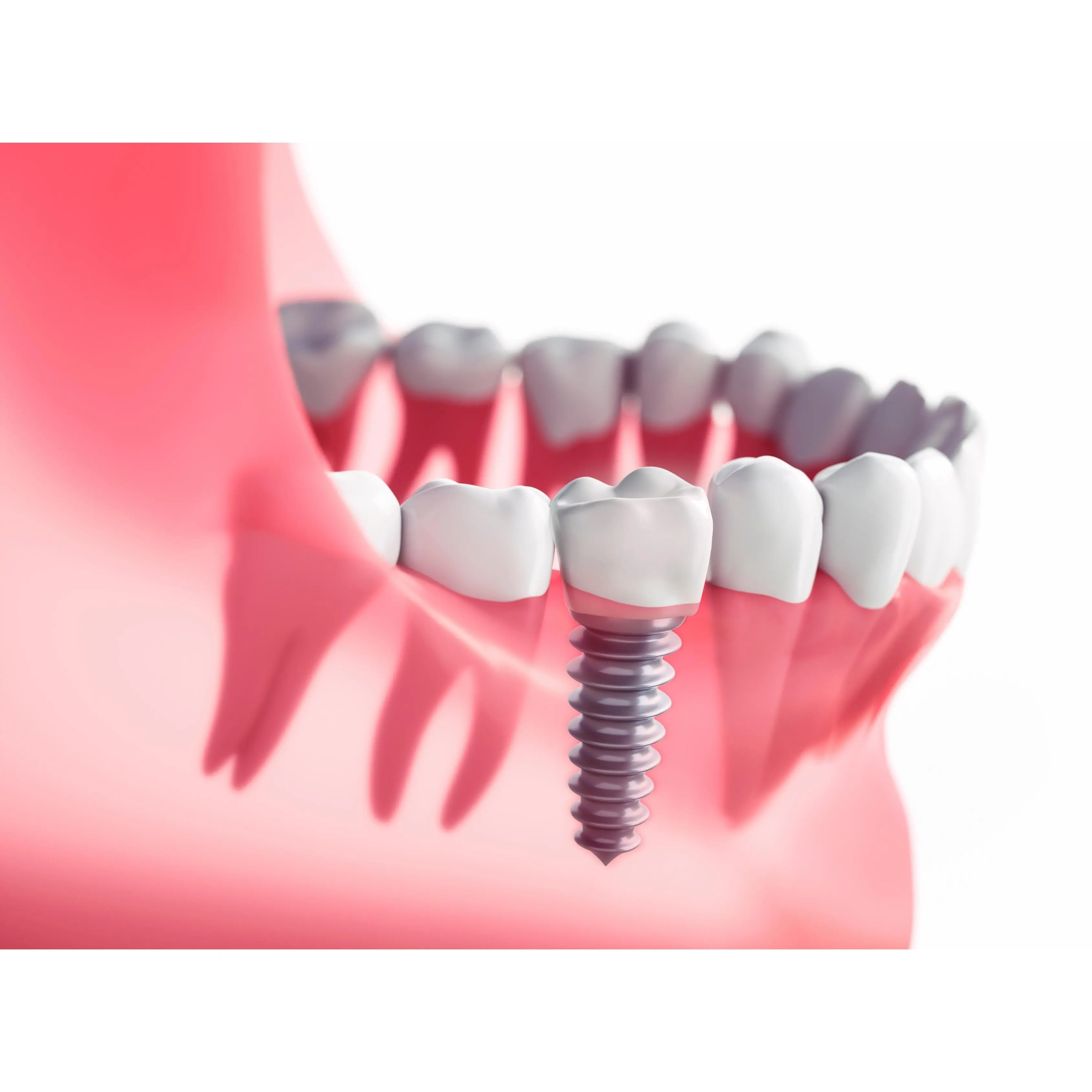 egeport implant show