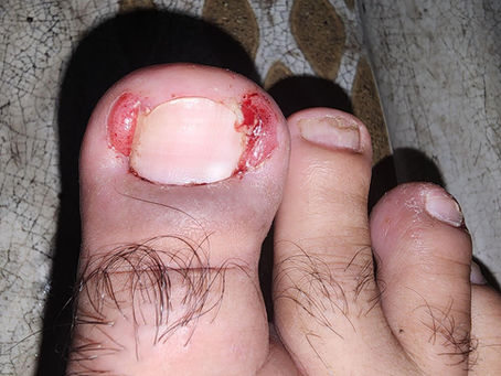 Ingrown Toenail
