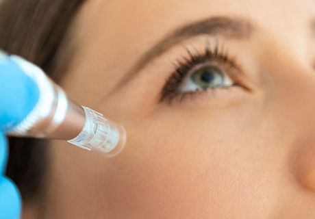 #Microneedling