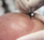 Scalp Micropigmentation