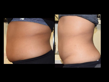 Cryotherapy Fat Freezing