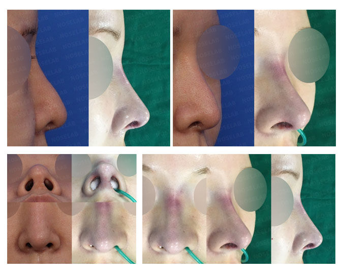 closed rhinoplasty korea before and after collage showing correction of long, deviated, and bulbous nose with columella reinforcement using rib cartilage through closed approach