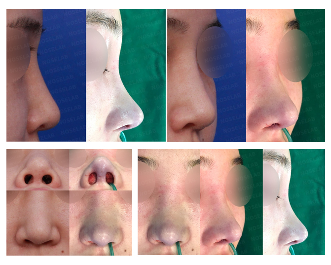 Before and after rhinoplasty showing bulbous nose tip correction, columella lengthening, and nostril balancing at Noselab Plastic Surgery
