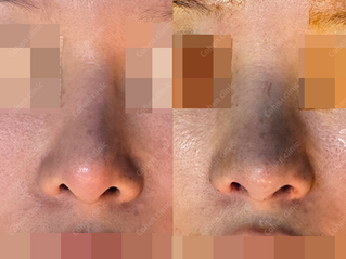Closed rhinoplasty(revision) + tip plasty(donated rib) + silicone + bulbous nose correction + lowering starting point + deviated nose correction