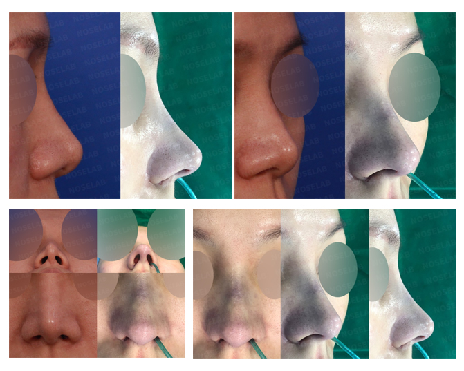 Before and after closed rhinoplasty showing correction of hanging columella and nose tip refinement at Noselab Plastic Surgery Seoul
