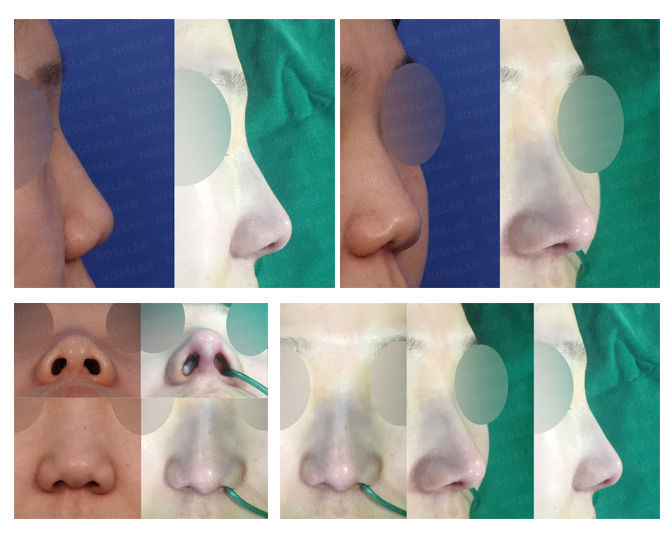 Before and after closed rhinoplasty Seoul for columella correction with flat and bulbous nose improvement – natural balance achieved without external incision.