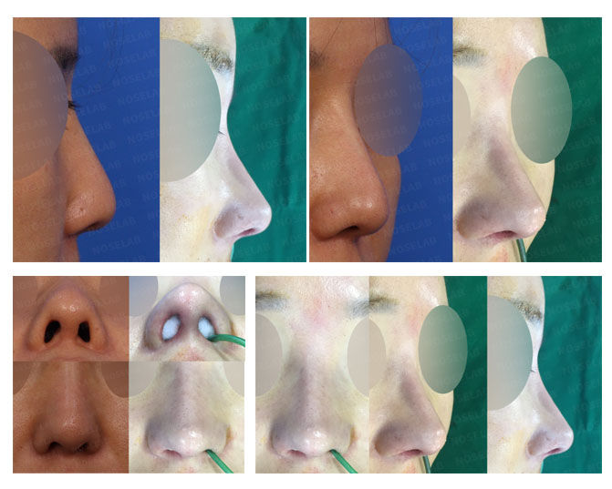 Before and after photo of Closed Rhinoplasty Korea correcting deviated and long nose with osteotomy, nasal length design, and nostril symmetry.