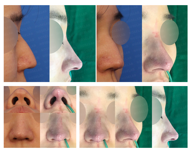 Deviated Nose, Hump, and Hanging Tip Correction Before and After