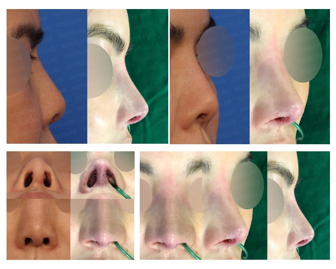 Short Nose Correction Korea - Columella Lengthening