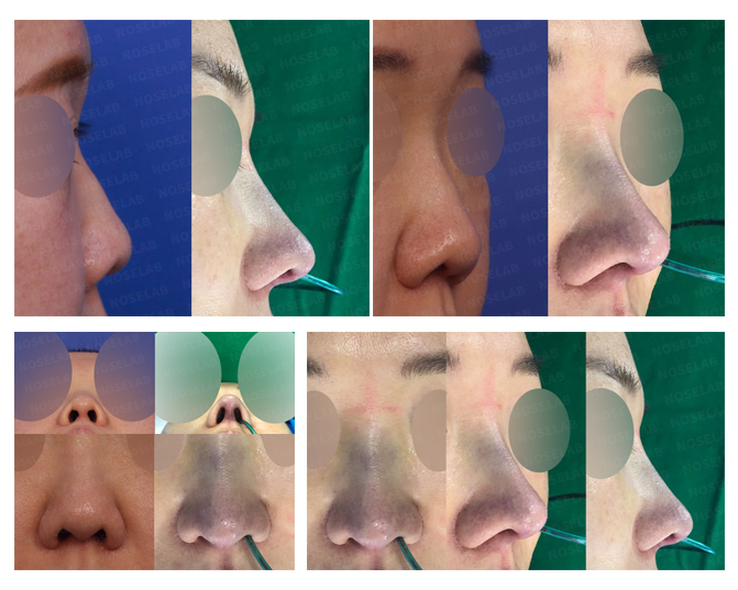 Before and after closed rhinoplasty for short upturned nose with alar retraction – Noselab Plastic Surgery, Seoul Korea