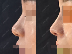 Closed rhinplasty + tip plasty(donated rib cartilage) + silicone + osteotomy + smile line implant + bulbous nose correction