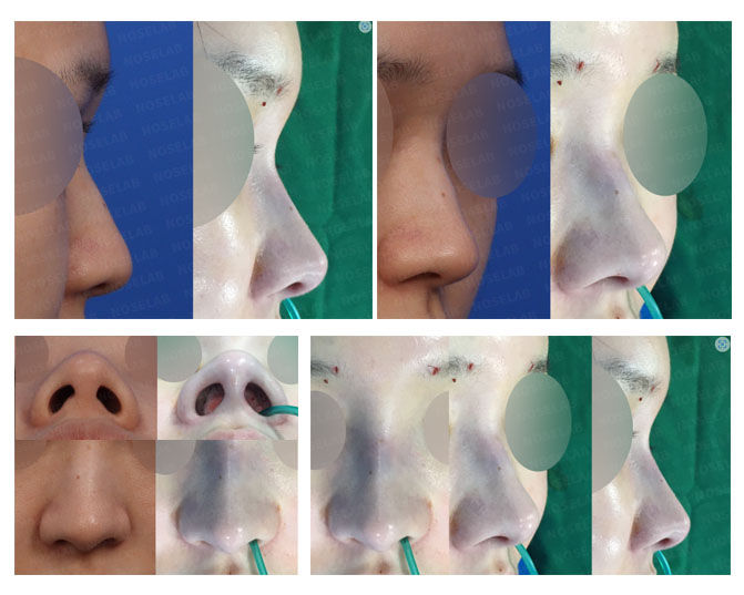 Before and after photo of Closed Rhinoplasty Korea correcting deviated and hump nose with hanging tip refinement and fat transplant.
