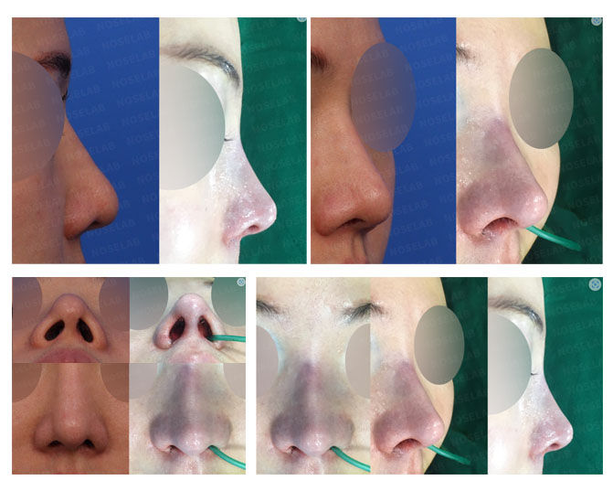 Before and after photo of Closed Rhinoplasty Korea correcting deviated, bulbous, and hump nose with notching correction, alar base reduction, and nostril symmetry.