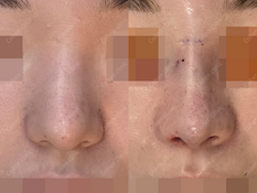 Closed rhinplasty + tip plasty(donated rib cartilage) + silicone + osteotomy + smile line implant + bulbous nose correction