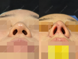 Closed rhinoplasty + rib cartilage + silicone + hump correction + osteotomy + bulbous nose corretion + alarplasty(inside) + columella lengthning + septoplasty + turbinoplasty + smile line implant 