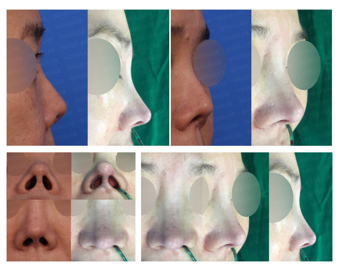 Before and after photo of Closed Rhinoplasty Korea correcting contracted, short, and upturned nose with stem cell therapy, own rib grafting, and nostril symmetry.