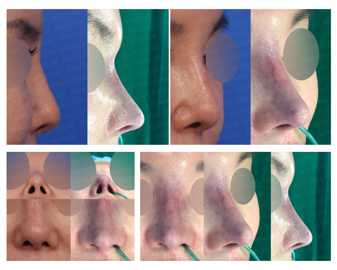 Contracted Nose Correction and Glabella Line Redesign Before and After