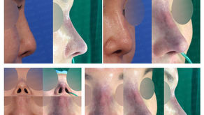 contracted nose + removing threads + designing glabella line + balancing nostrils' asymmetry