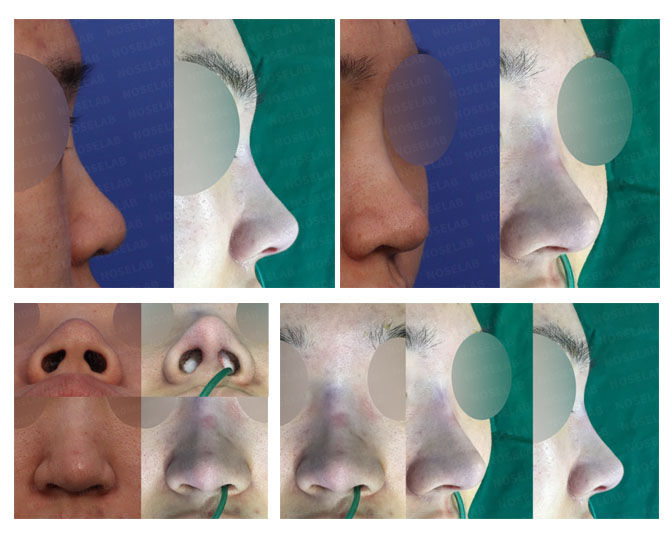 Columella correction Korea before and after – closed rhinoplasty for bulbous nose, nostril asymmetry, and depressed nose correction at NoseLab Seoul