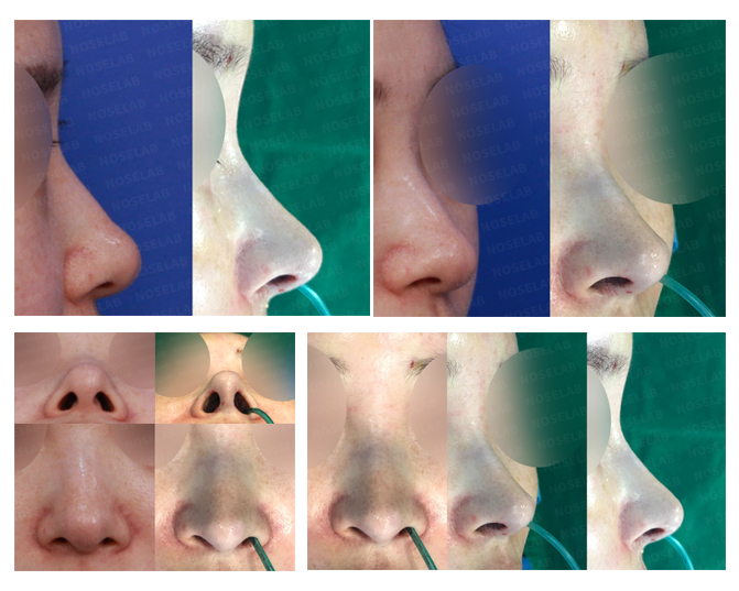 Before and after closed rhinoplasty for deviated nose correction at Noselab Plastic Surgery