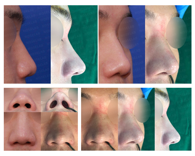 Before and after closed rhinoplasty for deviated nose and bulbous tip correction with columella lengthening at Noselab Plastic Surgery