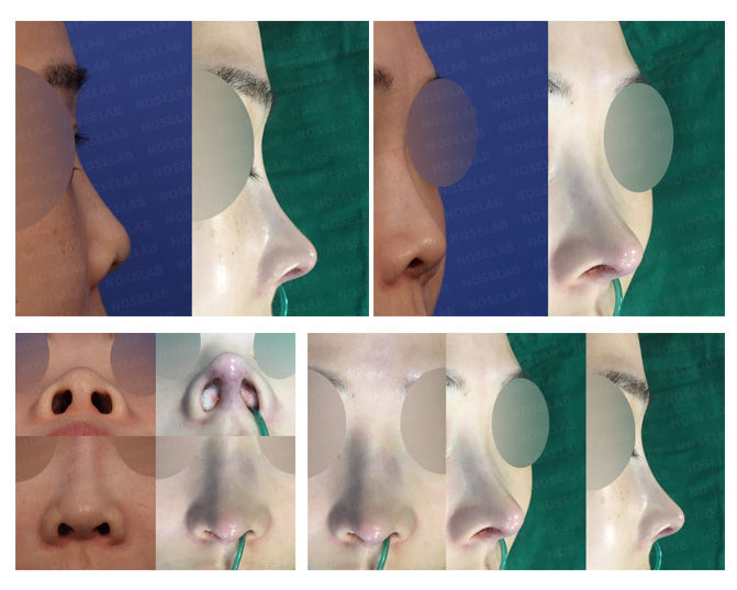 Before and after closed rhinoplasty Seoul for short and upturned nose correction – showing natural columella lengthening and improved nostril symmetry.