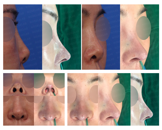 Revision Rhinoplasty Korea - Upturned Nose Correction Before and After