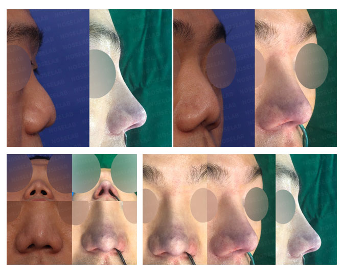 Before and after closed rhinoplasty for contracted short nose correction using autologous costal cartilage at Noselab Plastic Surgery Seoul Korea