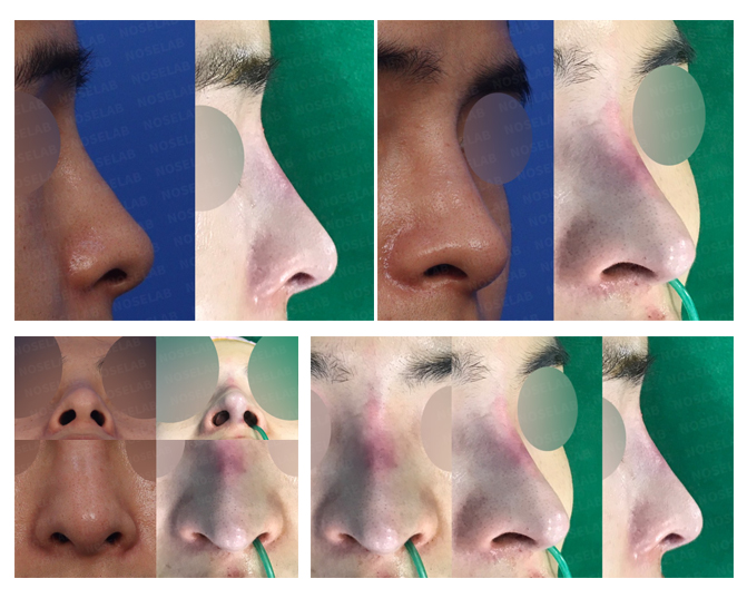 Closed Rhinoplasty Korea Upturned Nose Correction Before and After
