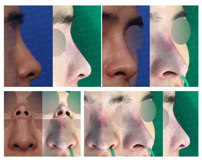 Closed Rhinoplasty Korea before and after – upturned nose correction with filler dissolving and columella insertion for natural nasal profile.