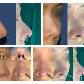 depressed nose + balancing nostrils' asymmetry(revision closed rhinoplasty)
