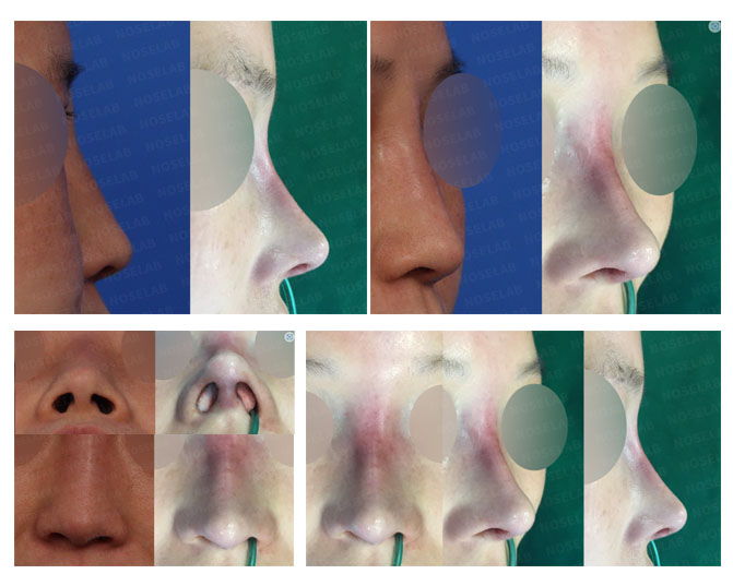 Before and after closed rhinoplasty side profile view