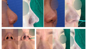 bulbous nose + upturned nose + designing length(closed rhinoplasty)
