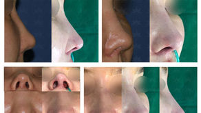 Designing volume + reshaping bulbous nose tip + balancing nostrils' asymmetry