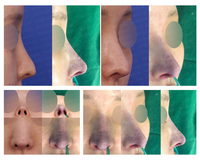 Closed Rhinoplasty Correction of Contracted and Hanging Nose