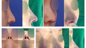 contracted nose + long nose + hanging nose + designing length(closed rhinoplasty)