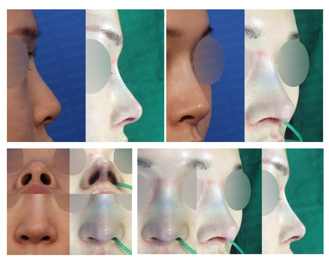 Nostril Asymmetry Correction Before and After
