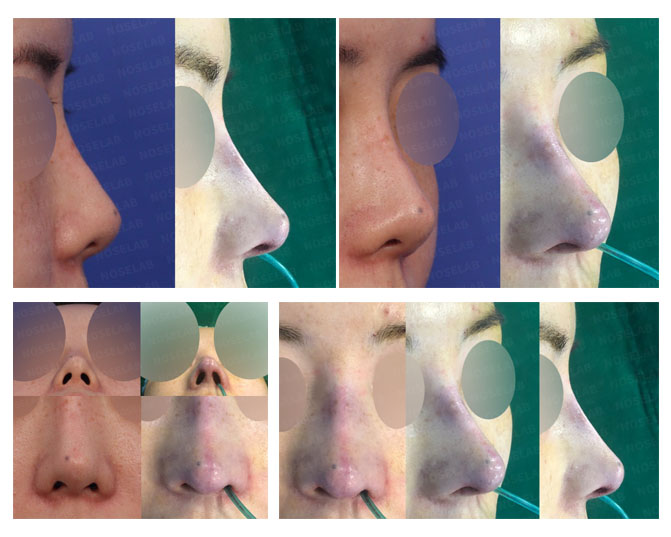 Before and after closed rhinoplasty for upturned nose correction and columella lengthening at Noselab Plastic Surgery Seoul Korea