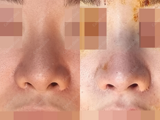 Closed rhinoplasty(revision) + droopy nose + slicone removal + own rib cartilage(tip and bridge) + nasolabial fold implant(rib cartilage) + columella inserting + lowering starting point 