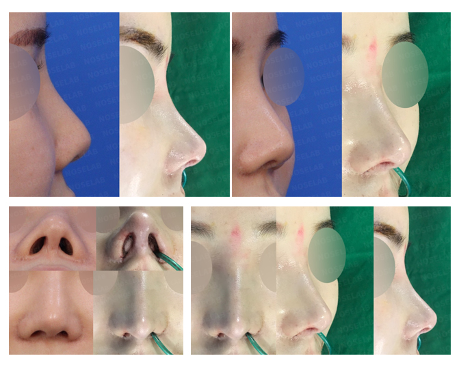 Before and After Short Nose Correction Korea
