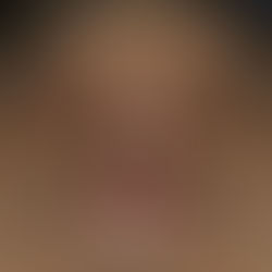 deviated nose + upturned nose + balancing nostrils' asymmetry + hanging columella