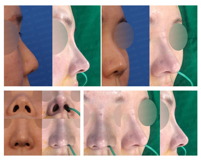 Columella Correction Korea before and after – closed rhinoplasty removing threads and lengthening small nose for balanced tip projection.