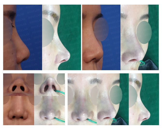 Before and after photo of Revision Closed Rhinoplasty Korea correcting deviated and small bulbous nose with length design and nostril symmetry.