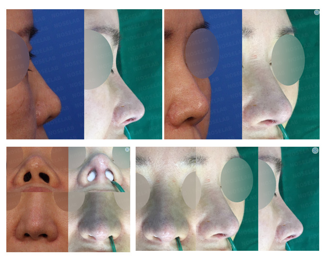 Before and After Closed Rhinoplasty Korea - Deviated and Upturned Nose
