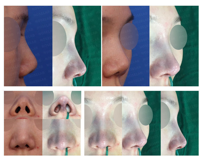 Before and after photo of Closed Rhinoplasty Korea correcting contracted and deviated nose with columella lengthening and notching correction.